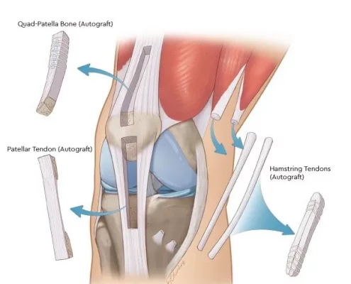 ACL graft ACL graft