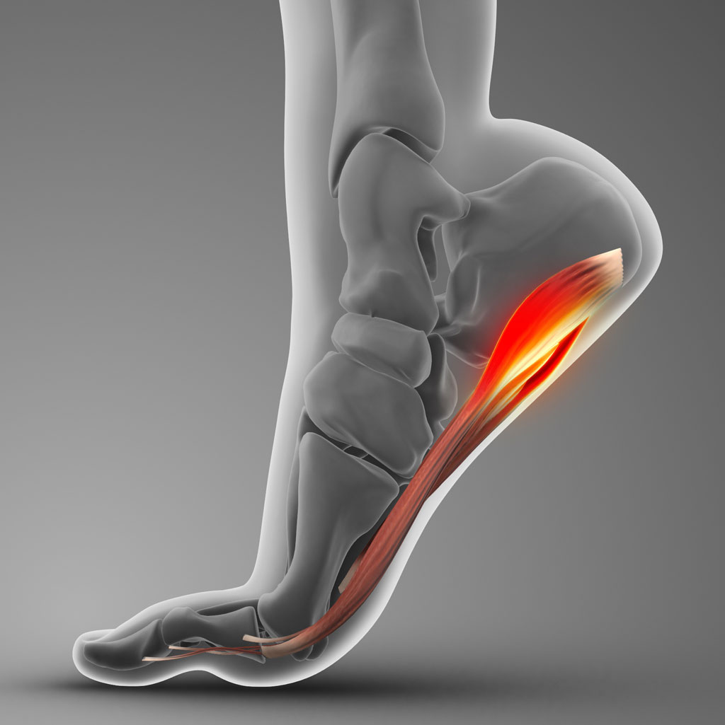 Peesoverbelasting van de voet